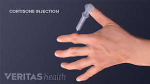 Cortisone Injection Risks and Side Effects Cortisone Injection Risks and Side Effects