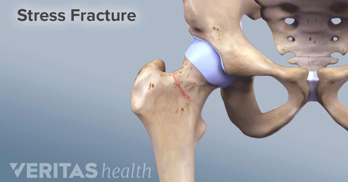 don-t-miss-the-signs-of-a-stress-fracture