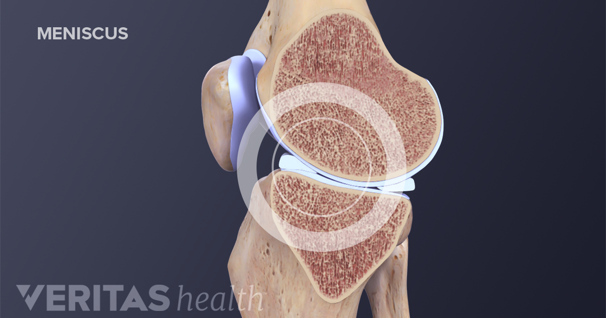 Recovering From Meniscus Repair Surgery