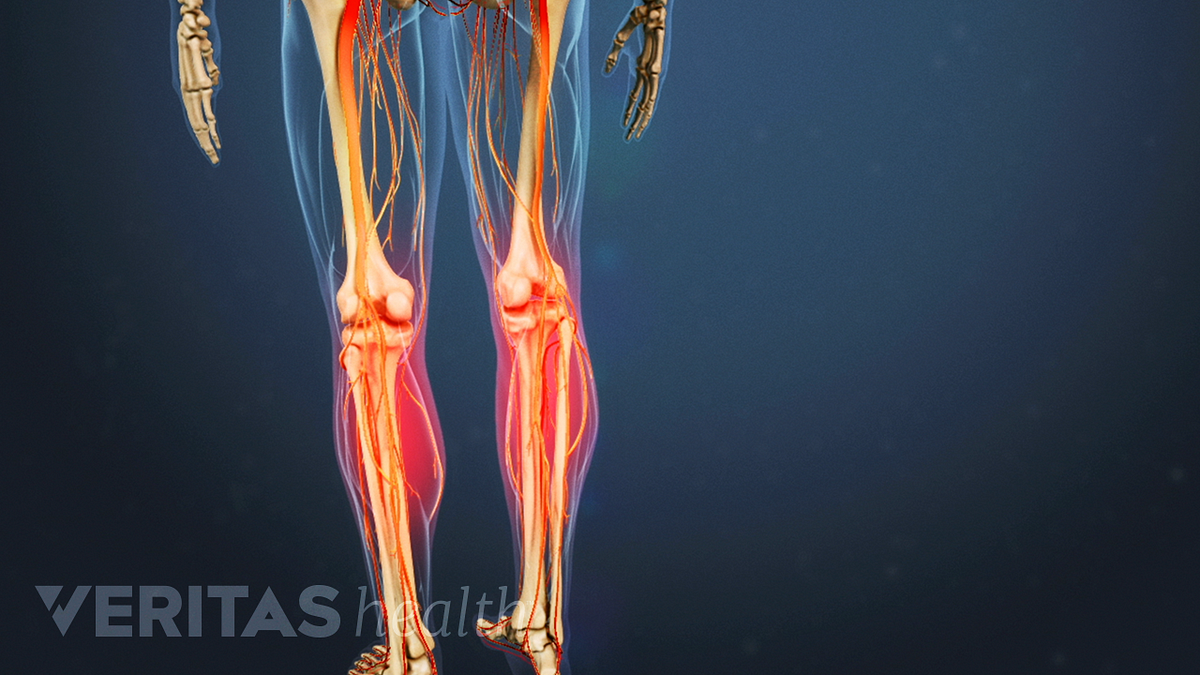 muscle weakness in legs