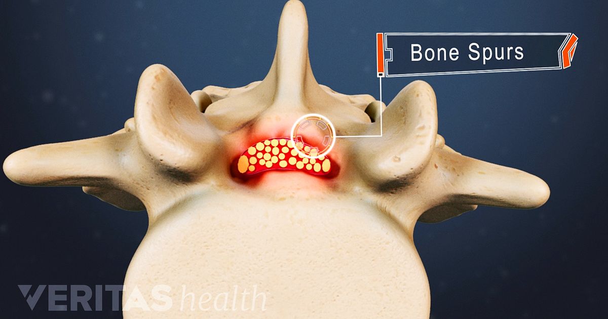 What Causes Bone Spurs In Lower Back