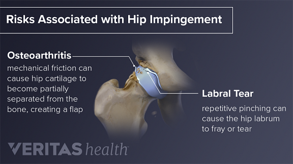 Hip Impingement Causes Treatment Test For Femoral Ace - vrogue.co