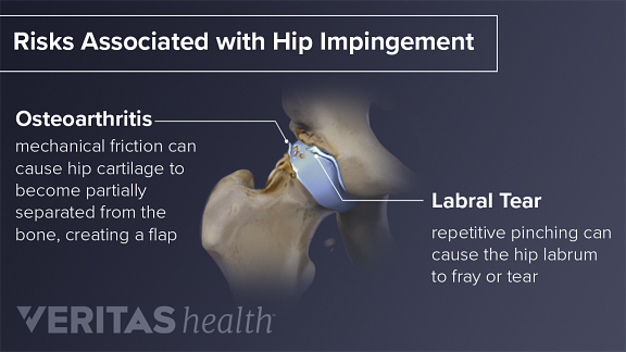 Pain Due to Hip Impingement (Femoroacetabular Impingement)