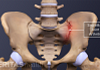 Anterior view of the SI JoInt labeling sacroiliac joint arthritis