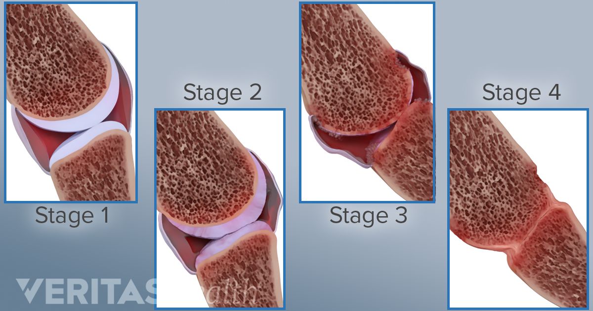 Treating Rheumatoid Arthritis—the Past, Present and Possible Future