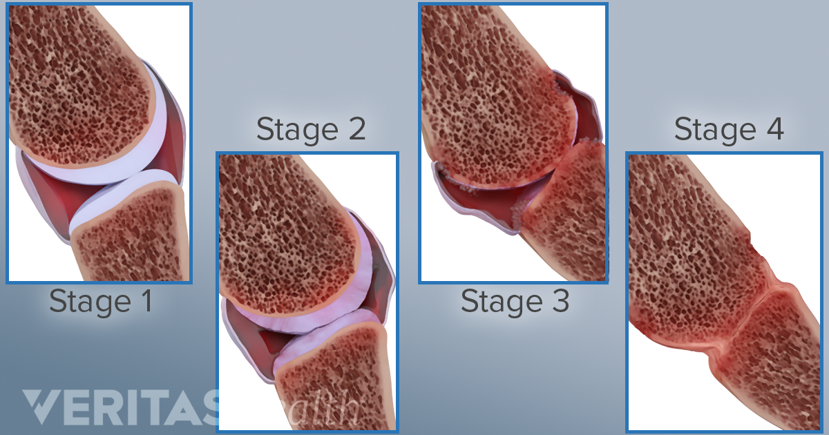 Rheumatoid Arthritis (RA) Diagnosis