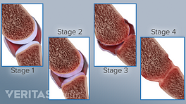 Medical illustration of the finger joints at the 4 different stages of rheumatoid arthritis