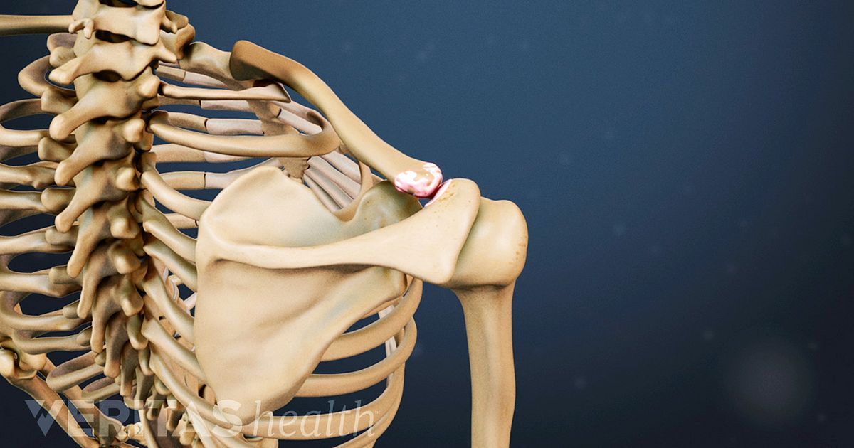 Rotator Cuff Injuries Causes and Risk Factors