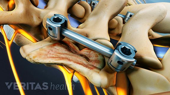 A Visual Guide To Posterolateral Gutter Fusion Surgery