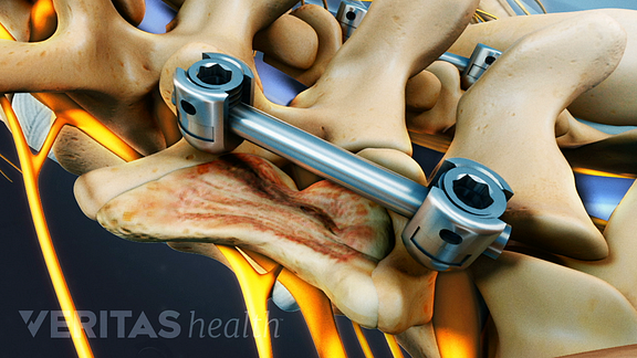 Posterolateral Gutter Spine Fusion Surgery