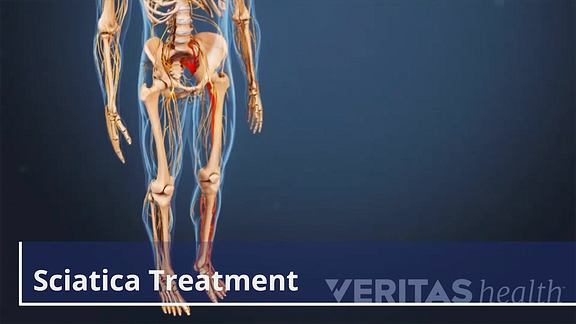 Posterior view of the lower body showing sciatica nerve pain traveling down the leg labeling sciatica treatment.