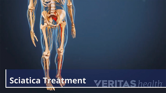 Sciatica treatment