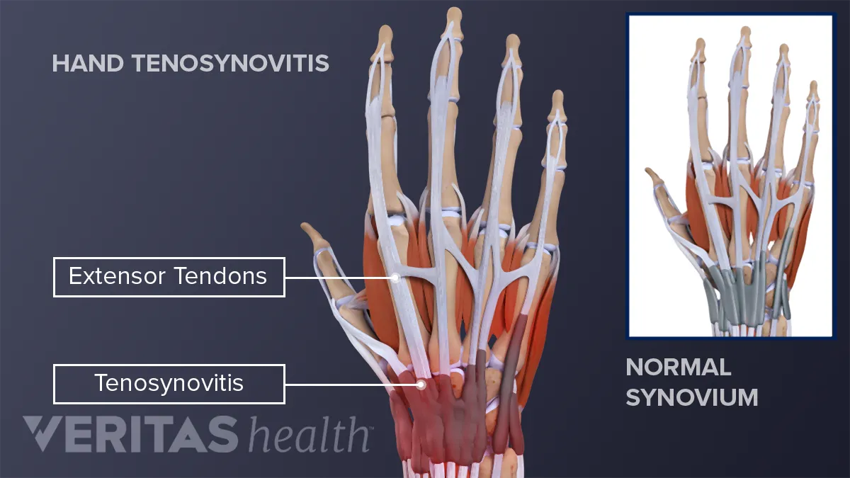 Osteoarthritis vs. rheumatoid arthritis - Mayo Clinic