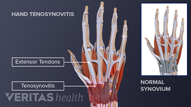 tendons in your thumb