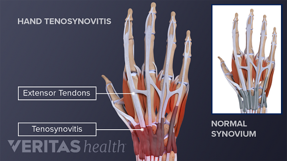 carpal synovitis kezelés artróziskezelés