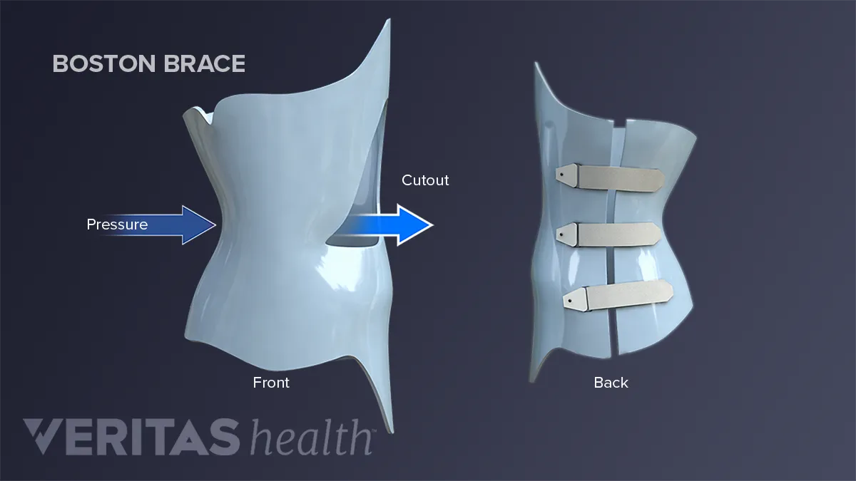 Boston Brace RC  Asymmetrical Custom Scoliosis Brace