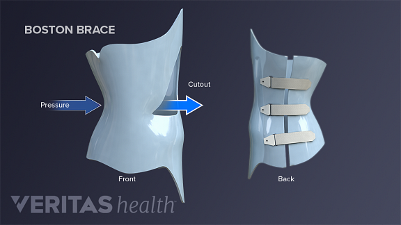 types of scoliosis braces