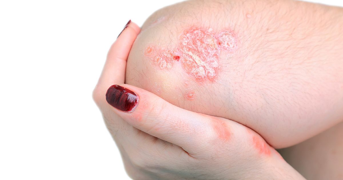 How to stop shingles pain