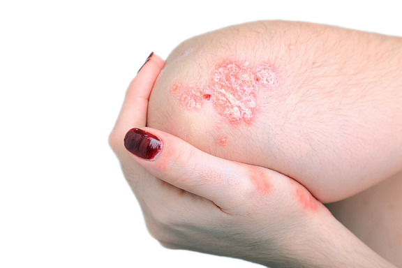 Psoriatic arthritis on elbow on the knee.