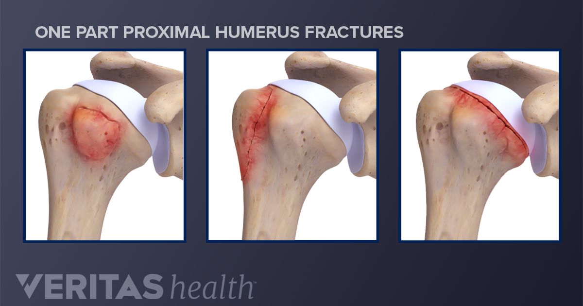 proximal-humerus-fractures-of-the-shoulder