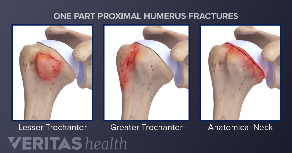 closed fracture of proximal end of right humerus