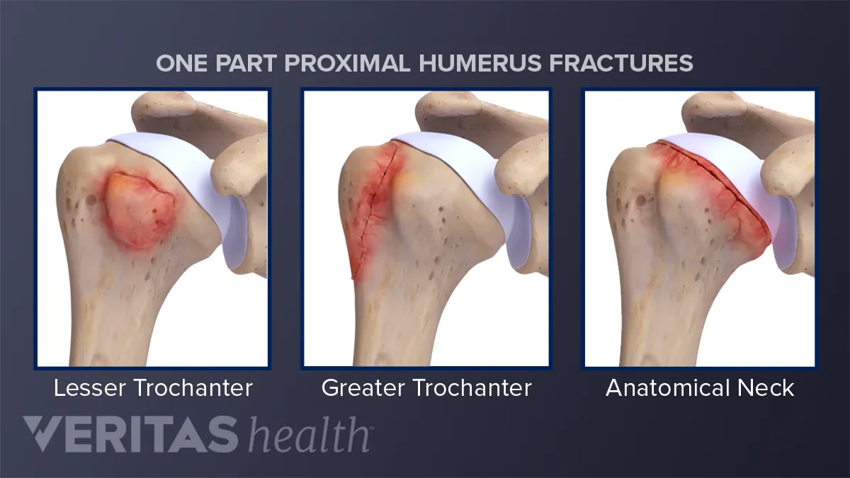 open humerus fracture