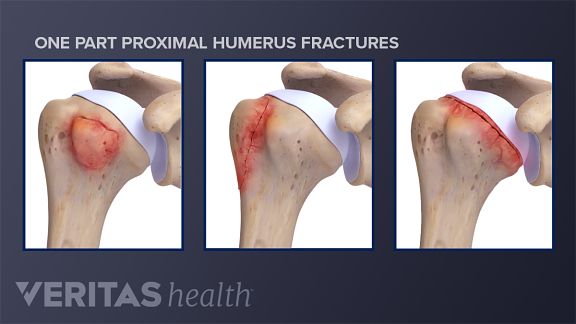 proximal humerus fractures of the shoulder