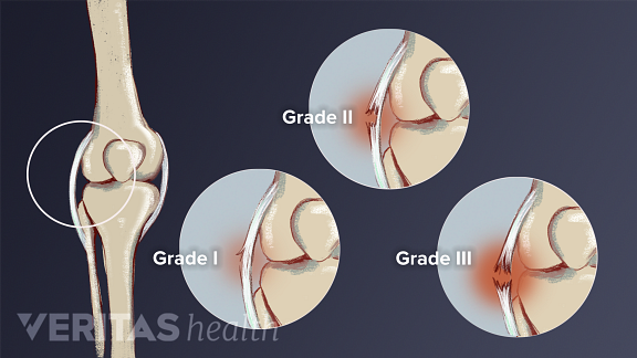 twisted knee cap