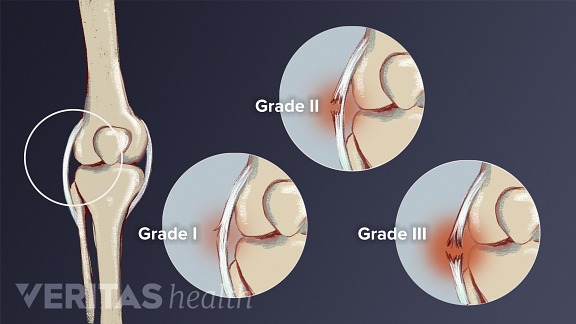 What Is a Knee Sprain?