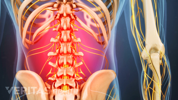 Medical illustration of the lower spine highlighted in red, indicating pain, numbness or tingling.