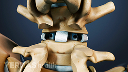 Posterior view of a PLIF implant in the the lumbar spine nerve roots.