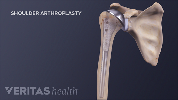 Shoulder-Arthro