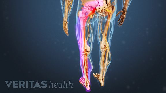 Sciatica Nerve Pain