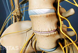 Cervical Osteophytes: Bone Spurs in the Neck