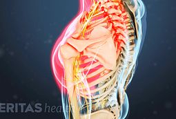 osteophytes spurs bone cervical pain symptoms spine facet radiculopathy osteoarthritis arthritis diagnosis neck