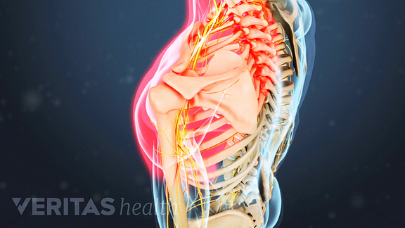 shoulder pain from cervical radiculopathy