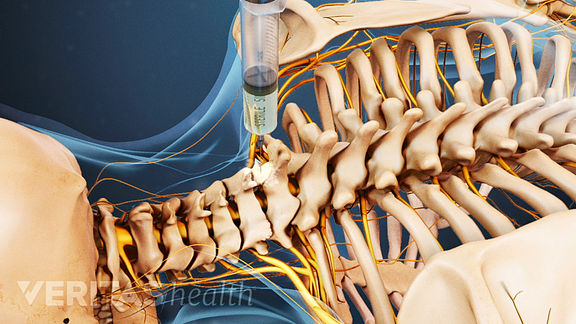 Posterior view of cervical and thoracic spine showing steroid anesthetic injection.