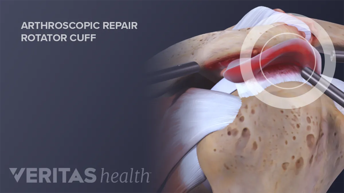 The Changing Approach to Rotator Cuff Repair
