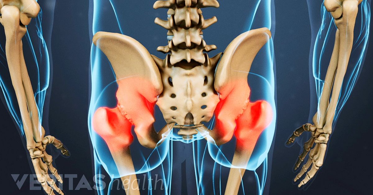 Hip Osteoarthritis