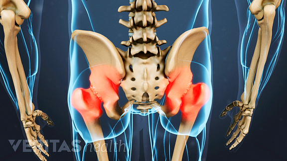Hip Osteoarthritis Video