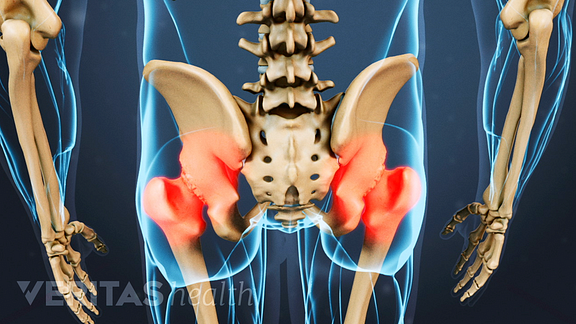 Medical illustration of the posterior side of the hips. The hip sockets are colored red indicating pain.