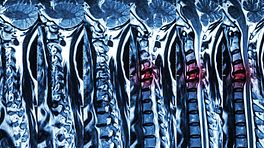 MRI scans of the spine.
