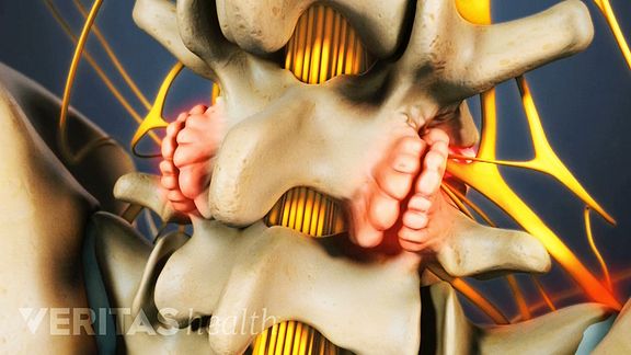 In spite of their name, bone spurs are actually smooth growths that don't always cause pain. However, they compress the nerves in the lumbar spine.