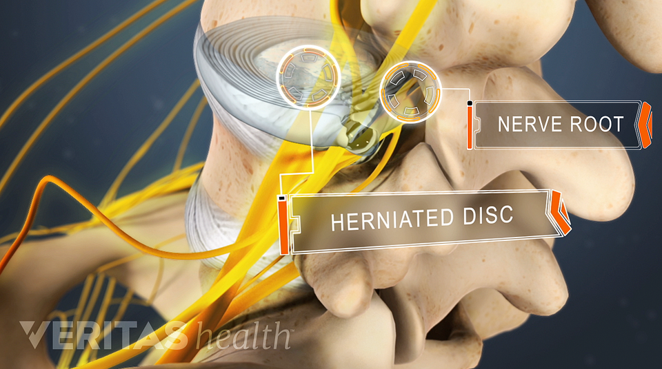 Herniated Disc Sciatic Nerve