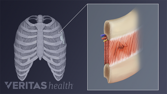 Causes Of Intercostal Muscle Strain