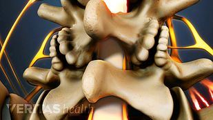 Spinal Stenosis