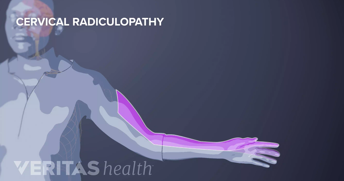 cervical-radiculopathy-icd-10-jualitapomsiblog