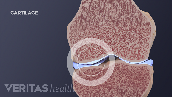 knee cartilage repair regeneration and replacement