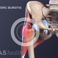 Anterior view of the pelvis highlighting the trochanteric bursitis in the hip.