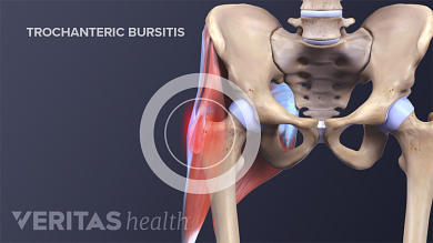 hip trochanteritis aki gyógyul